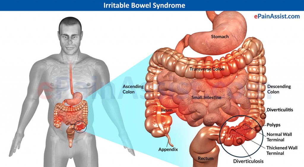 Irritable-Bowel-Syndrome-final