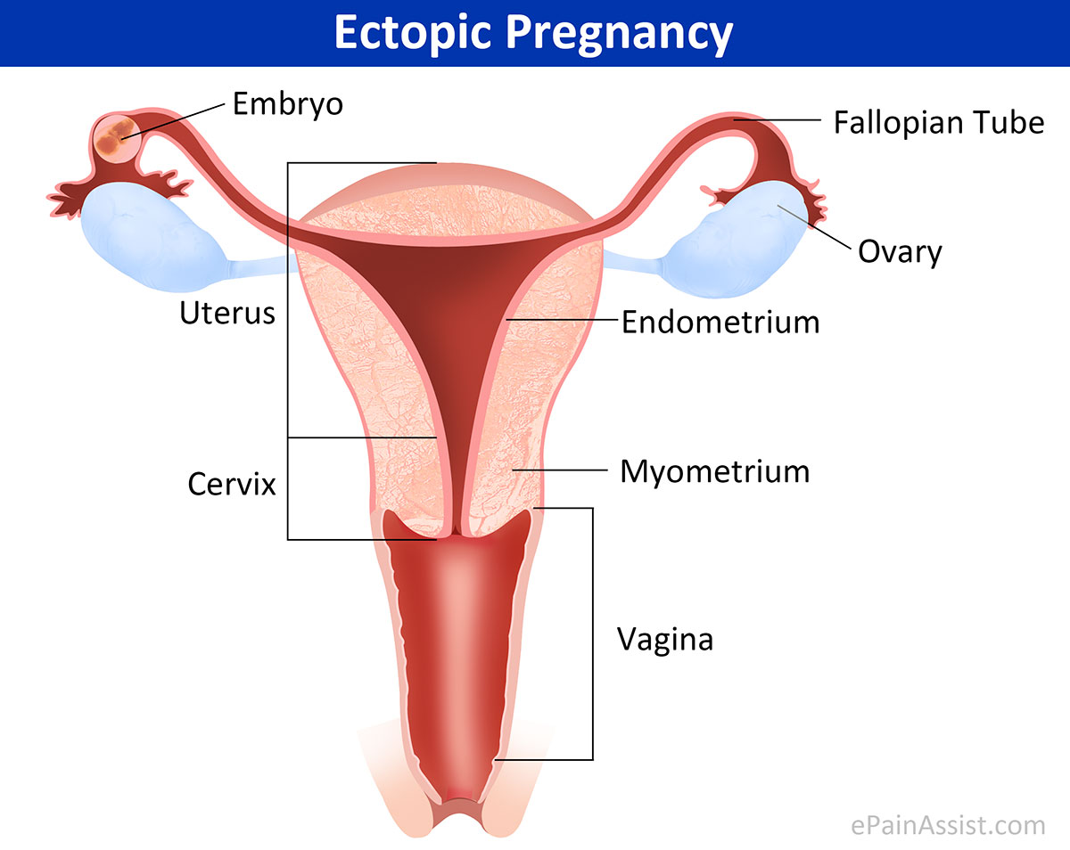 ectopic-pregnancy-or-eccysis