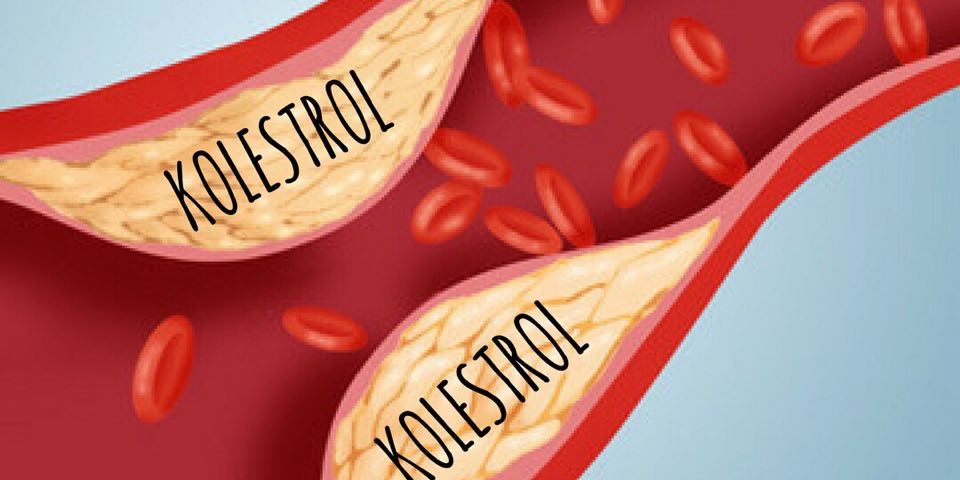 Ketahui 5 Punca Kandungan Kolestrol yang Berlebihan ...