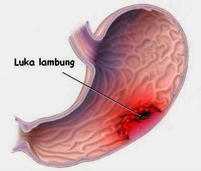 Penyebabasamlambung Rendah  4 Cara Mengatasinya