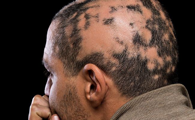 alopecia boleh menyebabkan seseorang mengalami masalah botak bertompok